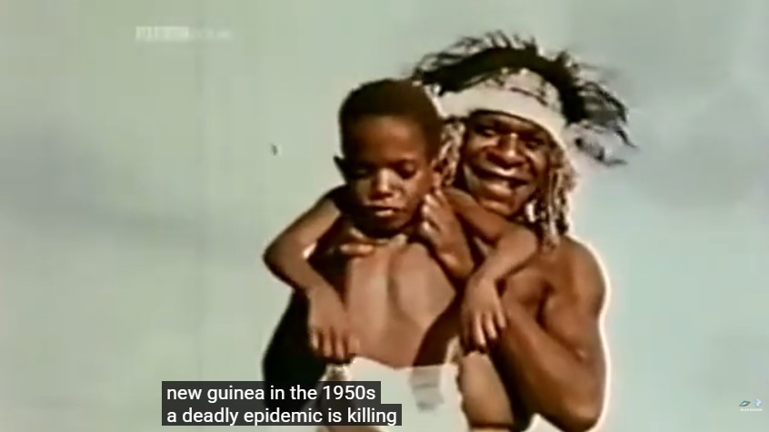 Un père papou tient dans ses bras son enfant malade du kuru. La légende indique qu'une épidémie mortelle a éclaté en Nouvelle-Guinée dans les années 50.